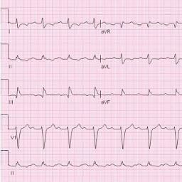 Nonspecific IVCD Wide QRS(>130 ms) but without typical