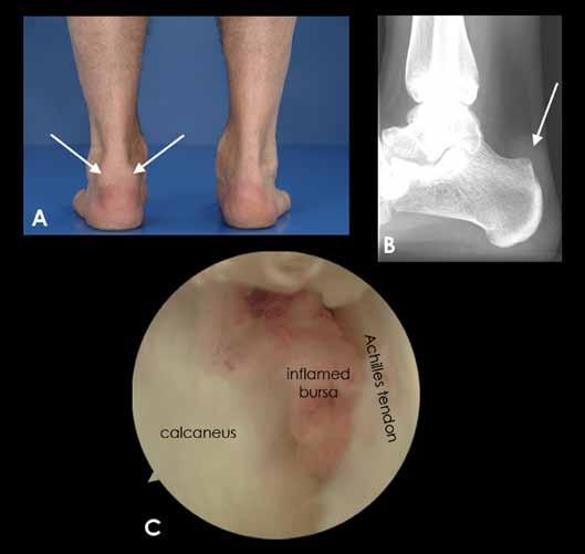 fluid in the distended retrocalcaneal bursa Chapter 9 Appearance of the weight- bearing lateral radiograph in retrocalcaneal
