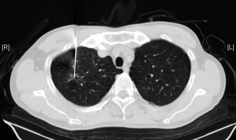 After excluding patients with multiple pulmonary nodules or confirmed malignant or metastatic tumors, 116 SPN cases were treated in our unit from September 2011 to October 2014.