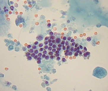 Cytopathology of Thyroid Nodules Fine Needle Aspiration: Limitations Insufficient or indeterminate in 21-31% of cases 1,2