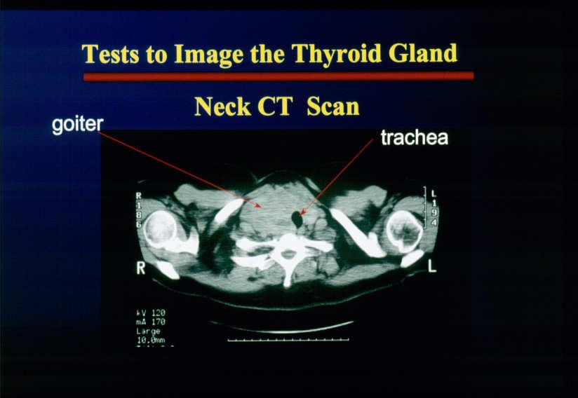 Nuclear Medicine Thyroid Imaging Thyroid Scanning