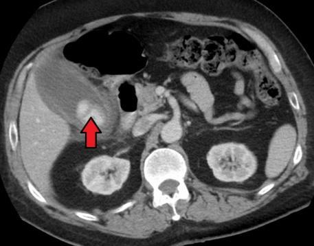 Fig: 3 Acute cholecystitis with gallbladder wall thickening, a large gallstone, and a large gallbladder Right upper quadrant abdominal ultrasound is most commonly used to diagnose cholecystitis.