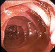 CP Diagnosis is Elusive Pancreas Funtion Test epft Duodenal View Summary of (HISORT) Criteria (H) Histology (I) Pancreatic