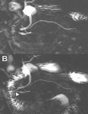 morphologic findings Extrapancreatic manifestations sclerosing cholangitis primary biliary cirrhosis retroperitoneal