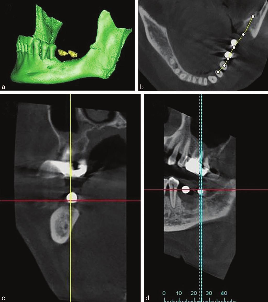 CBCT Analysis of Posterior Mandible for Bone Graft TABLE 1 Study subjects Subjects No. Age (y) No. of Extracted Teeth Time of Edentulous State (y) Men 18 53.41 6 7.34 3.93 6 2.02 5.62 6 3.