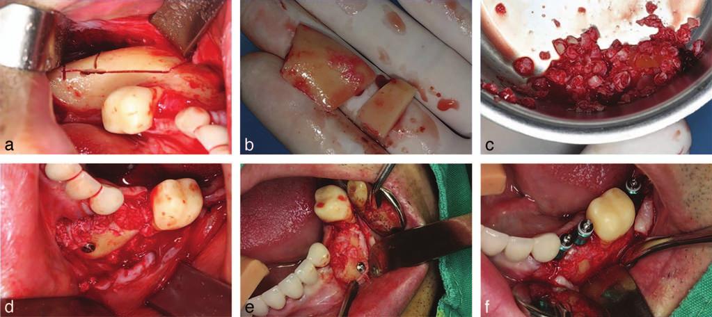 Song et al FIGURE 3. Clinical photographs of the procedure of mandibular body bone graft for atrophic mandible. (a c) Harvesting of mandibular body bone and particulated bone using bone mill.