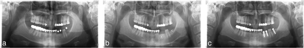 CBCT Analysis of Posterior Mandible for Bone Graft FIGURE 4. Postoperative change of the mandibular body bone donor site. (a) Preoperative assessment for atrophic mandible.