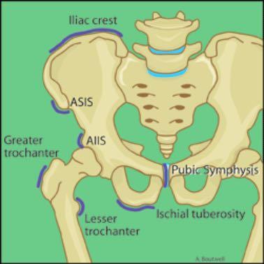 HIP/PELVIS Stress of neck (tension sided) Majority are compression sided, not tension If not treated, non-union AVN.