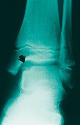 ANKLE Medial Malleolar Stress Rare Osteochondral Defect of