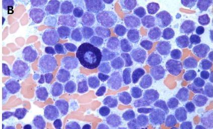 TOO MUCH MyD88 Over 90% of cases of the uncommon B cell lymphoma lymphoplasmacytic lymphoma (Waldenstrom s macroglobulinaemia) harbour an