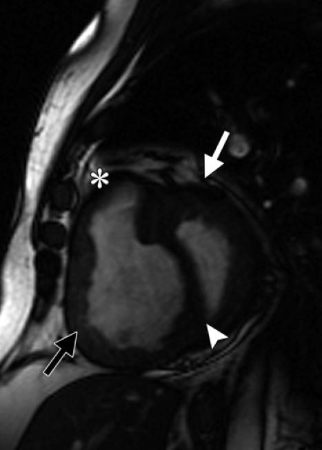 Straightening or leftward bowing of the interventricular septum; right ventricular dilatation Decreased