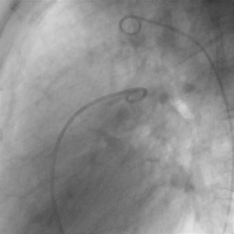 Catheterism: Forward pulmonary garadient
