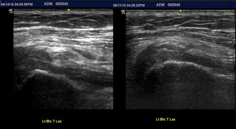 Below are pre and post images of the biceps tendon in short axis demonstrating a notable