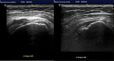 Below are pre and post images of the Subscapularis in it s visible long axis