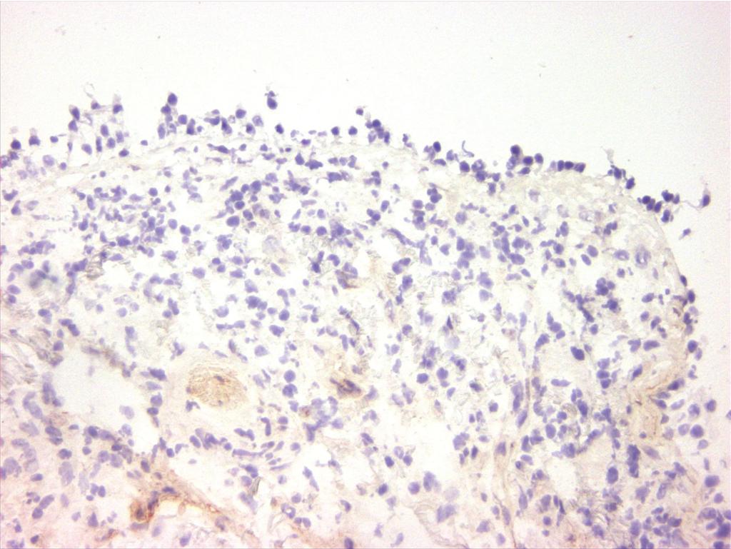 a uniform red-brown-stained band beneath the epithelial layer in asthma (A left panel).