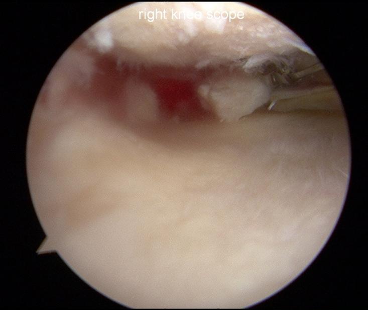 suggest meniscal extrusion due to radial/root