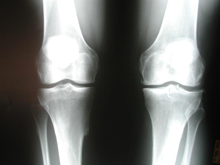Meniscal Injuries: Radiographs Always indicated Avoid the just get the MRI Reveals the