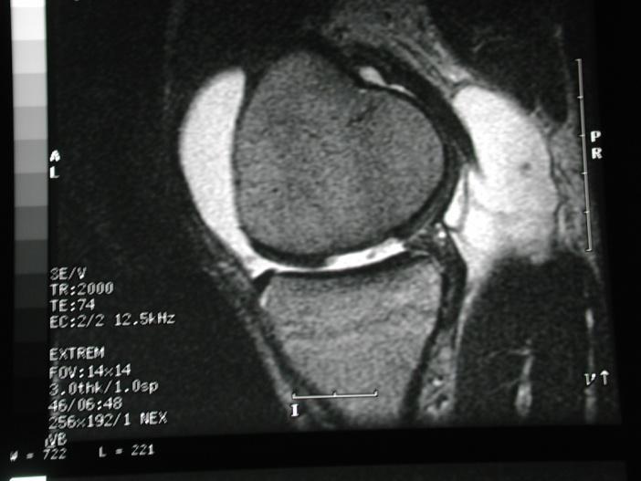 Meniscal Injuries: MRI Accurate anatomic