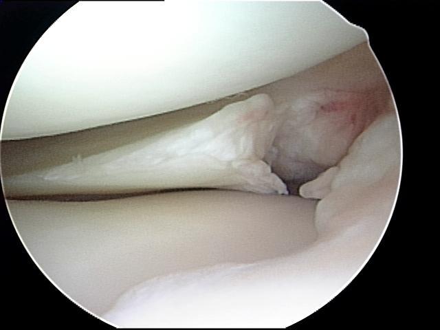 surgery (Shelbourne 2012, Marzo 2014) Fix (Noyes, Arthroscopy 2000, LaPrade AJSM