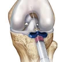 Meniscal Injuries: Biologic Augmentation Hutchinson,