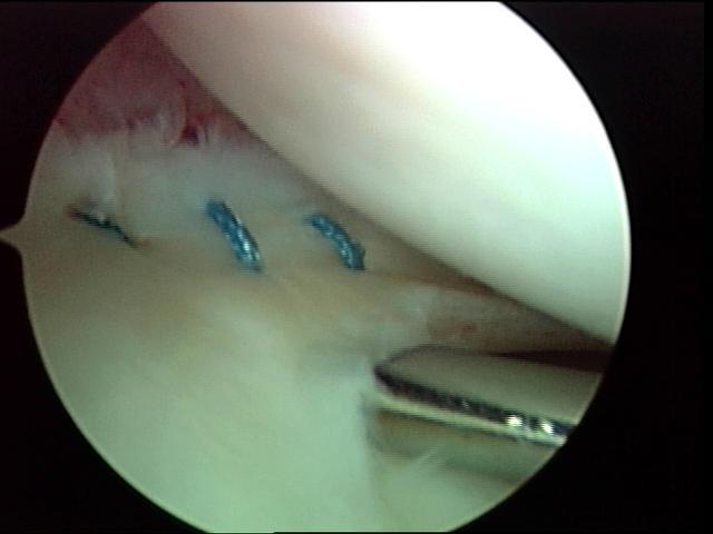 Meniscal Repair: Inside out with Accessory Incision Pro s Solid repair that allows aggressive