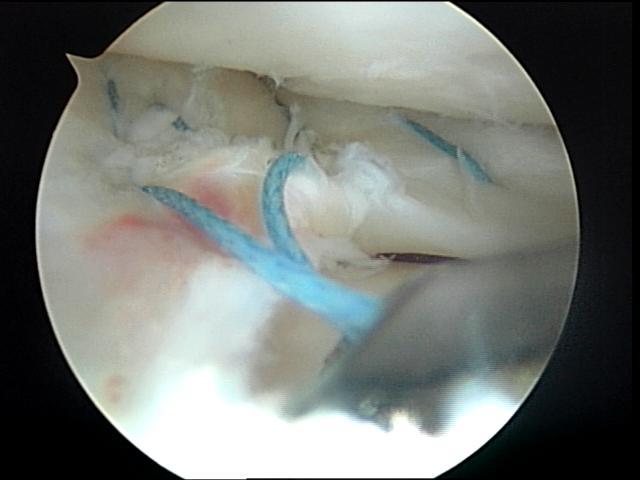 Meniscal Repair: Inside out Con s Labor intense