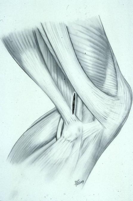 Meniscal Repair: Lateral Accessory Incision IT band-biceps interval Incision parallel to lateral