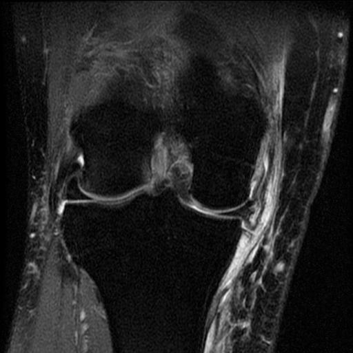 Meniscal Injuries: Root Injuries 20 year old male football