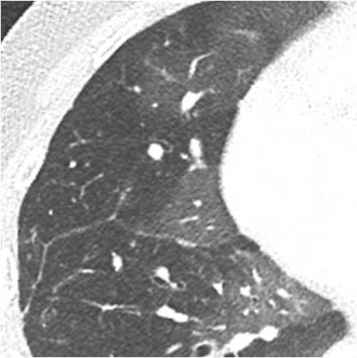 Iterative Reconstruction in DECT of Chest and Radiologists Preference A B C Fig. 2. Standard dose contrast enhanced-chest CT in 19-year-old man (BMI, 21 kg/m 2 ) with pulmonary hypertension. A-C.