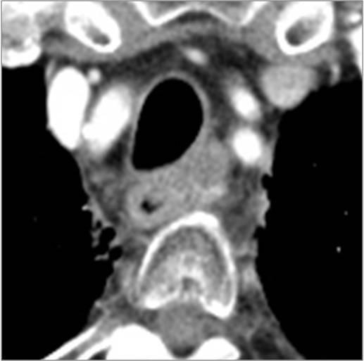 Hwang et al. A B C Fig. 4. Standard dose contrast enhanced-chest CT in 77-year-old man (BMI, 22 kg/m 2 ) with esophageal cancer.