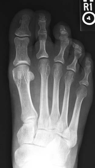 Exclusion criteria included previous ipsilateral midfoot or hindfoot surgery (17 patients), trauma (nine patients), inflammatory arthritis (nine patients), missing or inadequate radiographs (15