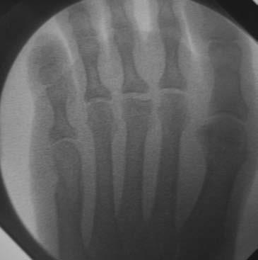 B, On anteroposterior fluoroscopy picture of the same foot rotated to obtain a true anteroposterior view impingement is no longer visible.