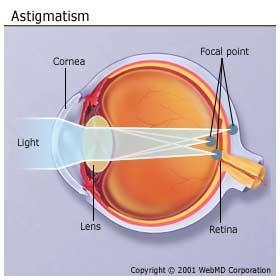 Astigmatism Caused by an irregular shaped cornea (normally) or lens that leads to