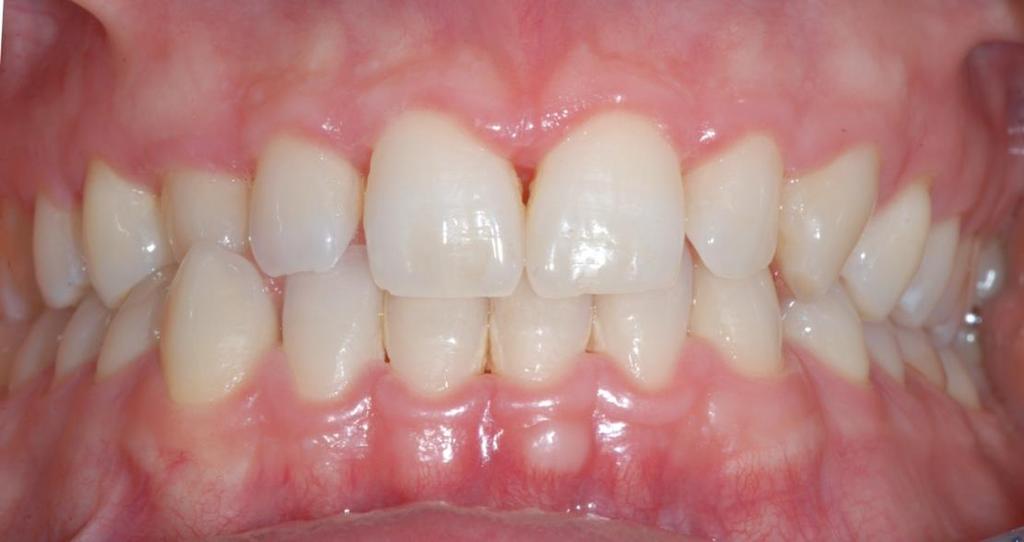 Baseline 1 Week Later Particularly in case of localized light to moderate gingival inflammation, associated to stresss as aggravating factor, PHOTOBIOSTIMULATION