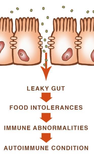 Leaky Gut Protocol This is the protocol where foods are taken out in a major way It is as a last resort and for people with such major issues, you need to calm things down as much as possible It is