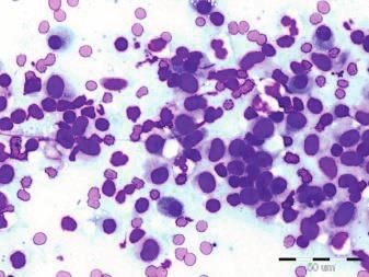G. stained, x400 Cutaneous lymphomas are characterized by a monomorphic population of tumoral lymphoblasts, with eucromatic nuclei and numerous nucleoli. Mitoses can be frequent and atypical (Fig.
