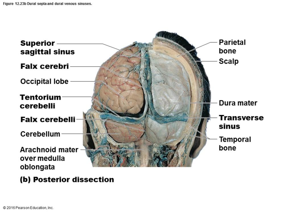 Dura mater Strongest meninx Made up of two layers of fibrous connective tissue Periosteal layer attaches to inner surface of skull Found only in brain, not spinal cord Meningeal layer: true external
