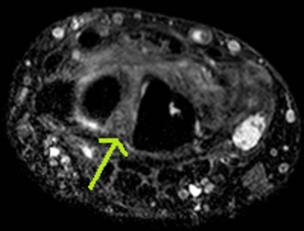 Fig. 6: Non-contrast MR examination in high resolution, 3D mffe