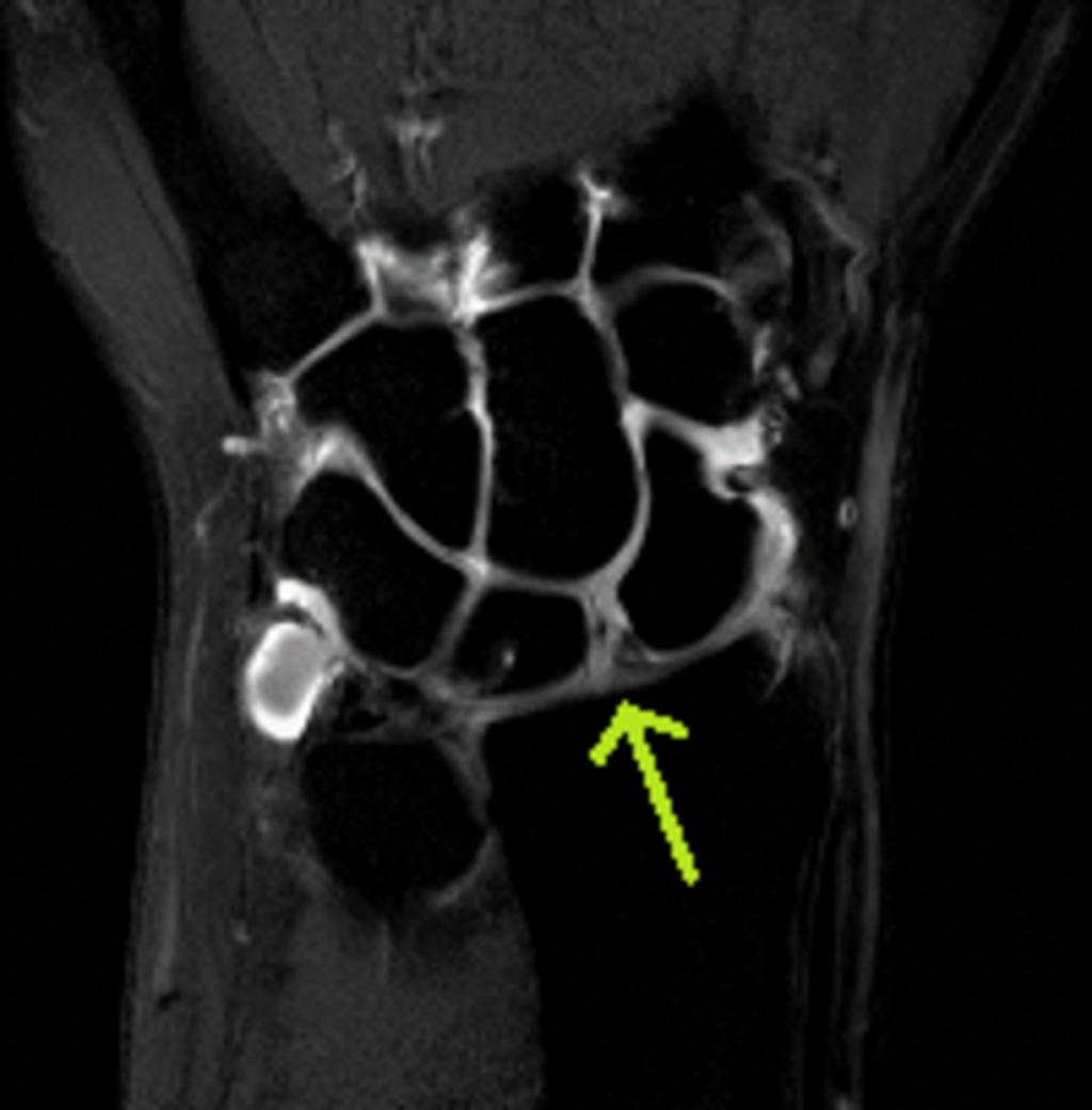 Fig. 7: Direct MR arthrography in the same patient, T1 TSE SPIR