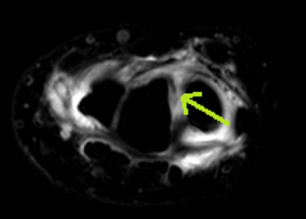 Fig. 8: Direct MR arthrography in the same patient, 3D WATS