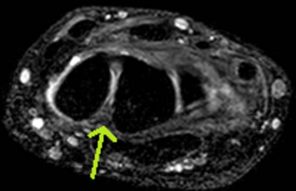 Fig. 2: Non-contrast MR examination in high resolution, 3D mffe