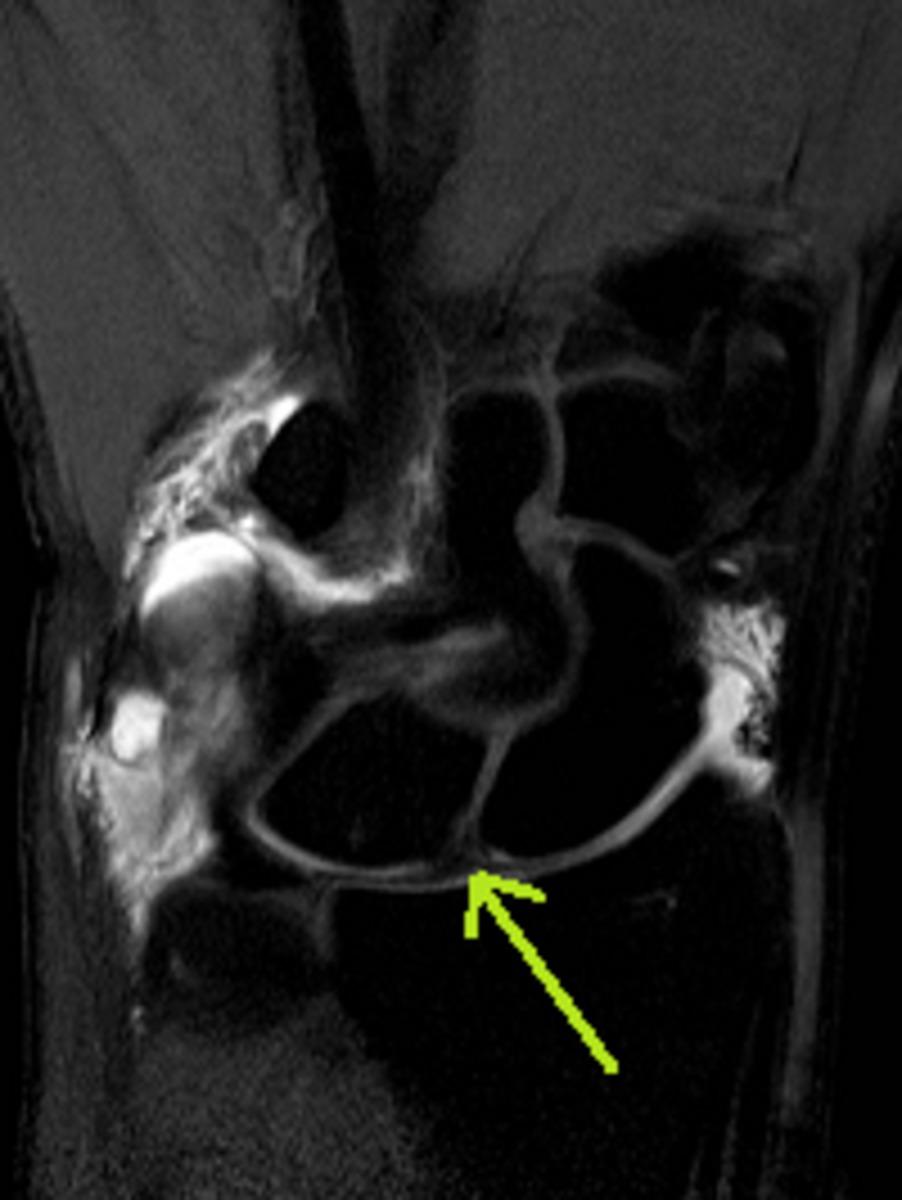 Fig. 3: Direct MR arthrography in the same patient, T1 TSE SPIR