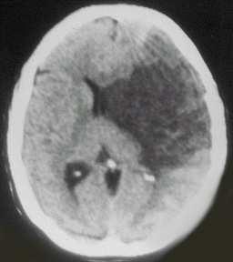 DISEASES OF CNS