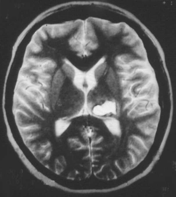 DISEASES OF CNS Cerebrovascular