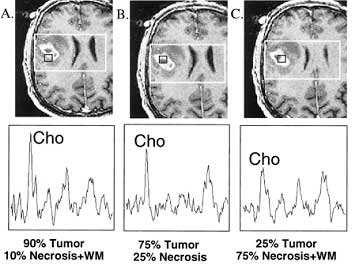 Changed metabolism MR spectroscopy: Tumor or not tumor Tumor diff.