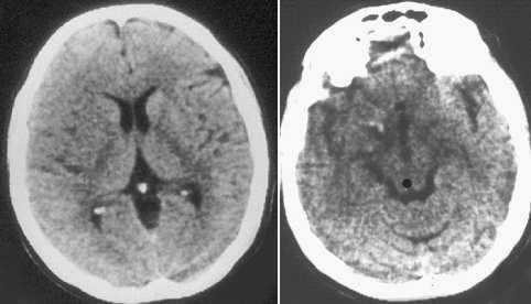sign Early ischaemic signs CT perfusion:
