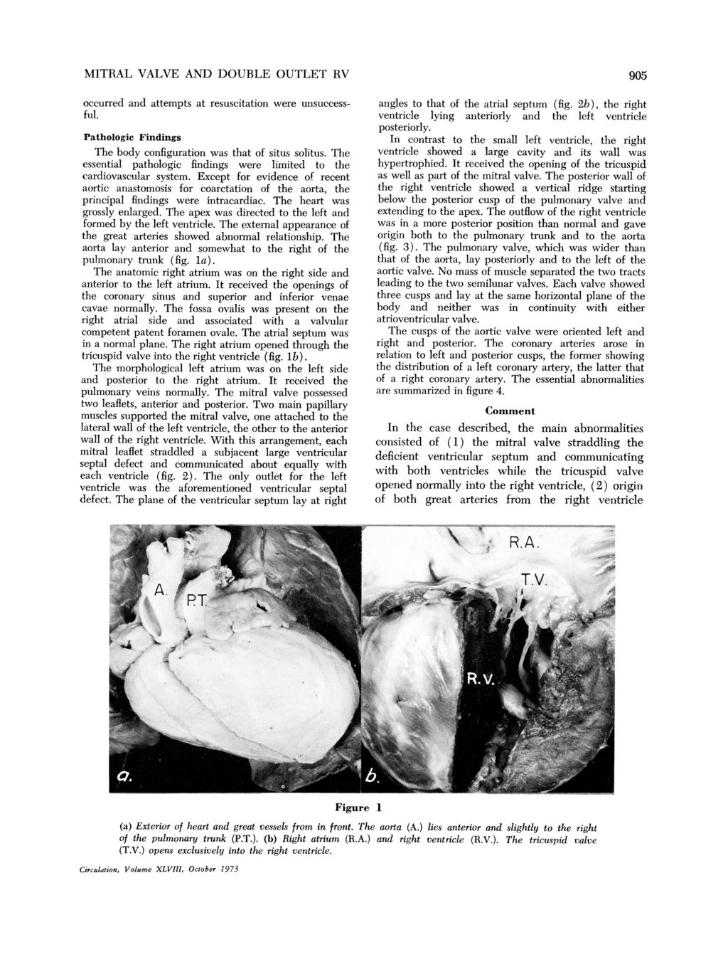 MITRAL VALVE AND DOUBLE OUTLET R9 occurred and attempts at resuscitation were unsuccessful. Pathologic Findings The body configuration was that of situs solitus.