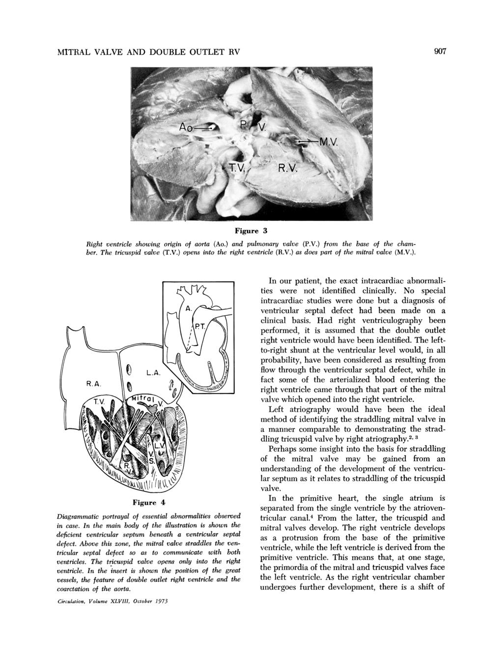 907 MITRAL VALVE AND DOUBLE OUTLET RV _v r~~-d~ Figure 3 Right ventricle showing origin of aorta (Ao.) and pulmonary valve (P.V.) from the base of the chamber. The tricuspid valve (T.V.) opens into the right ventricle (R.