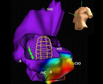 pool Interpolates back onto CT surface model Ablation