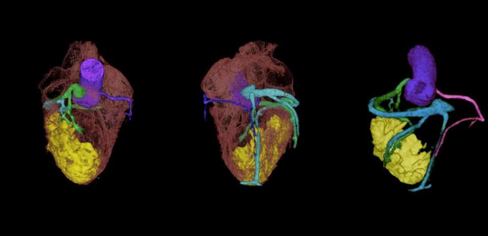 Fused 3D coronary MRA/3D scar map